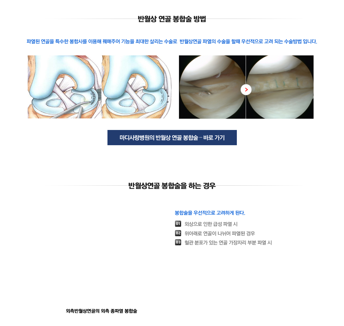 Meniscus Tears