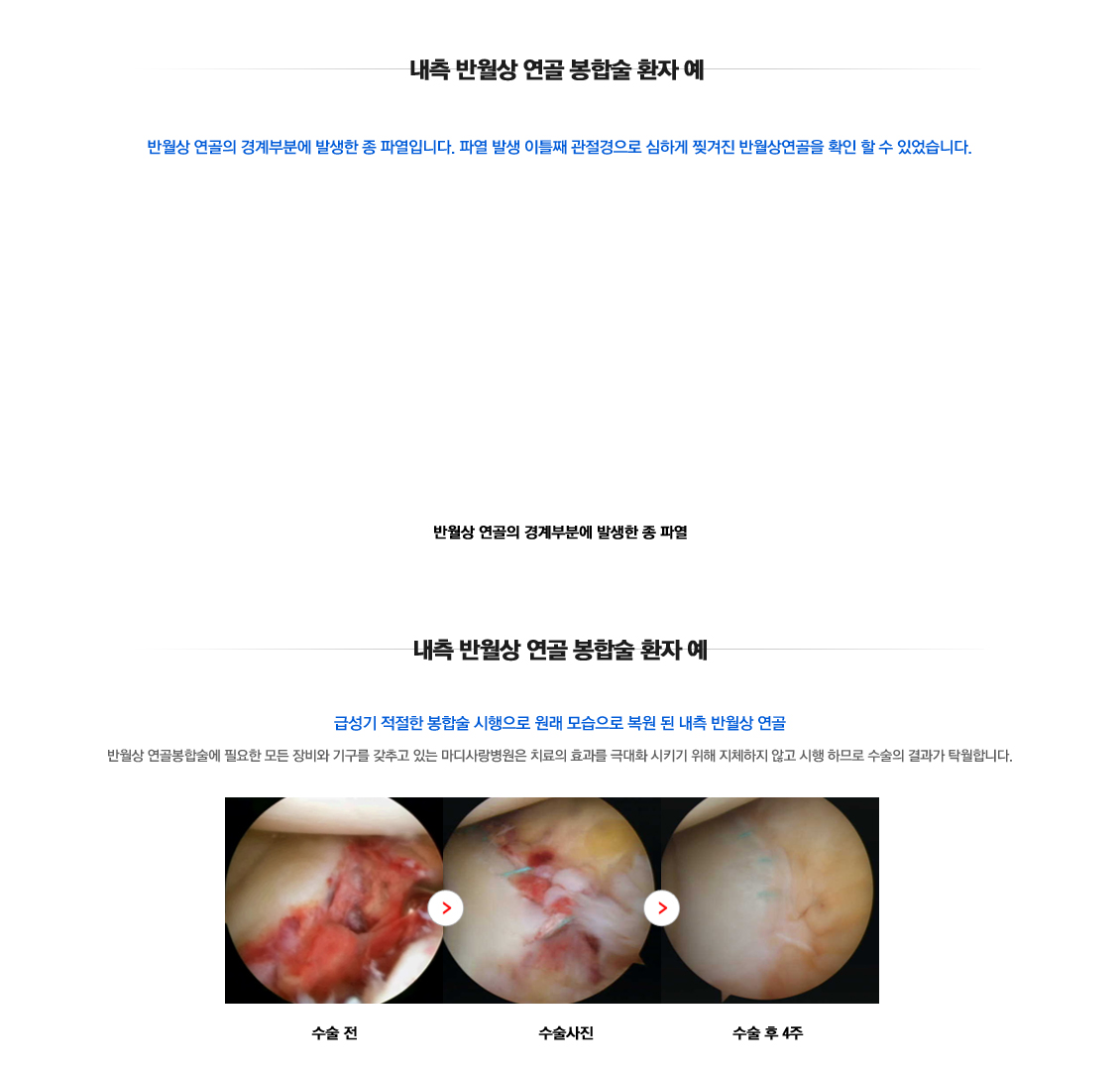 Meniscus Tears