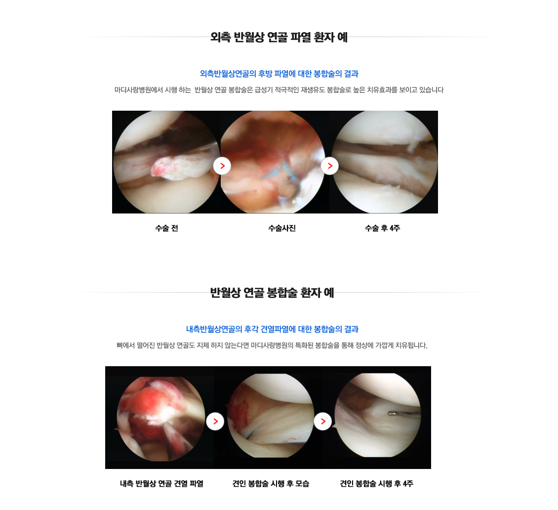 Meniscus Tears