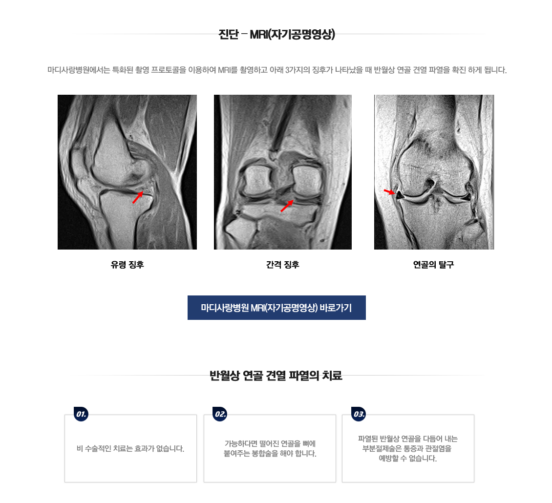 Meniscus Root Tears