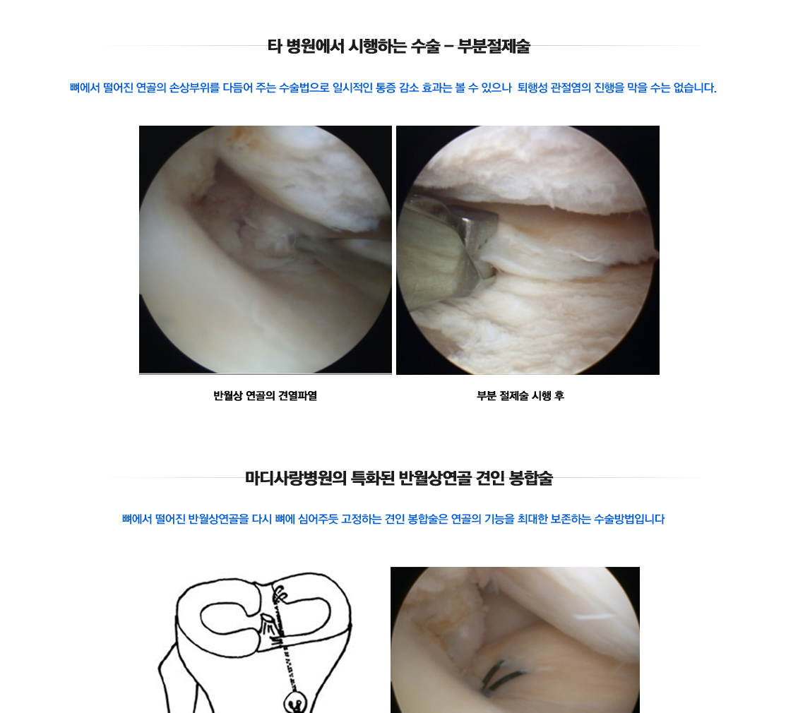 Meniscus Root Tears