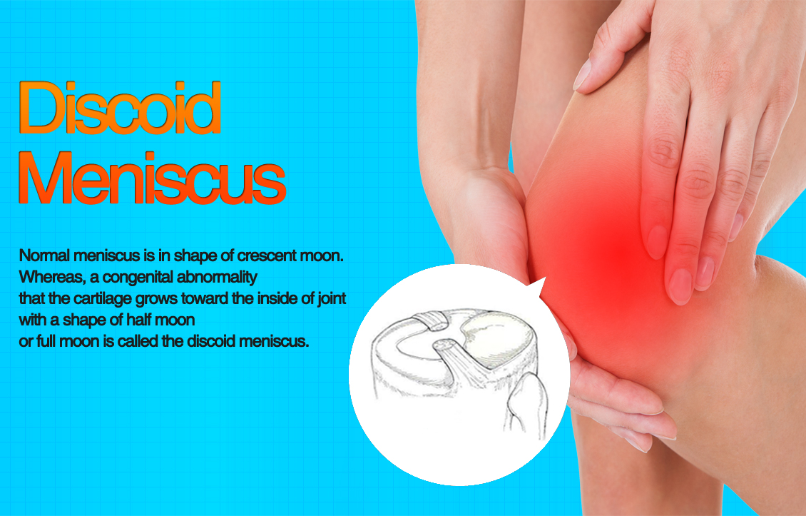 Discoid Meniscus