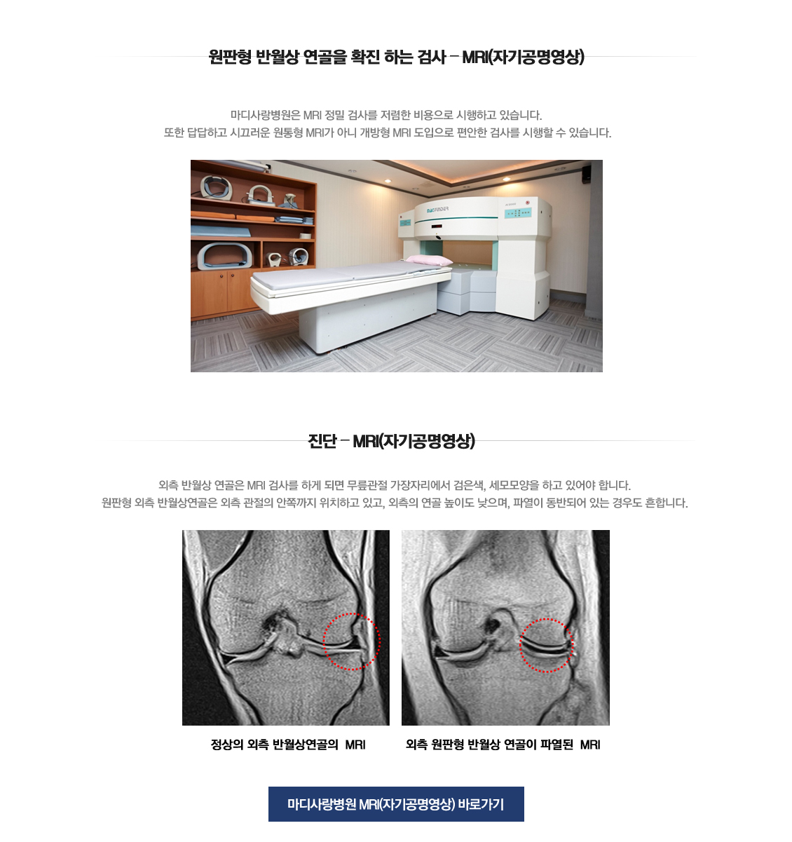 Discoid Meniscus