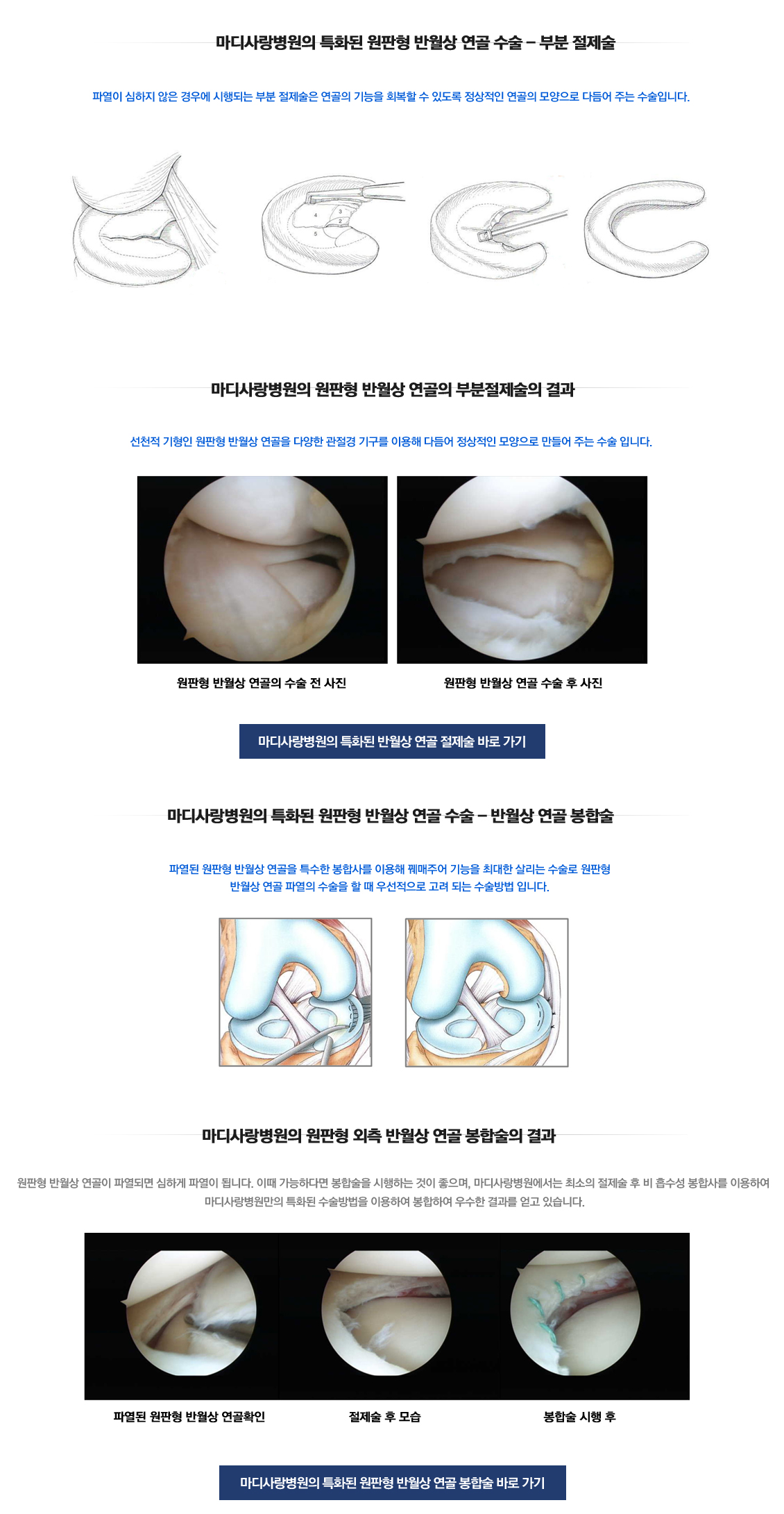 Discoid Meniscus