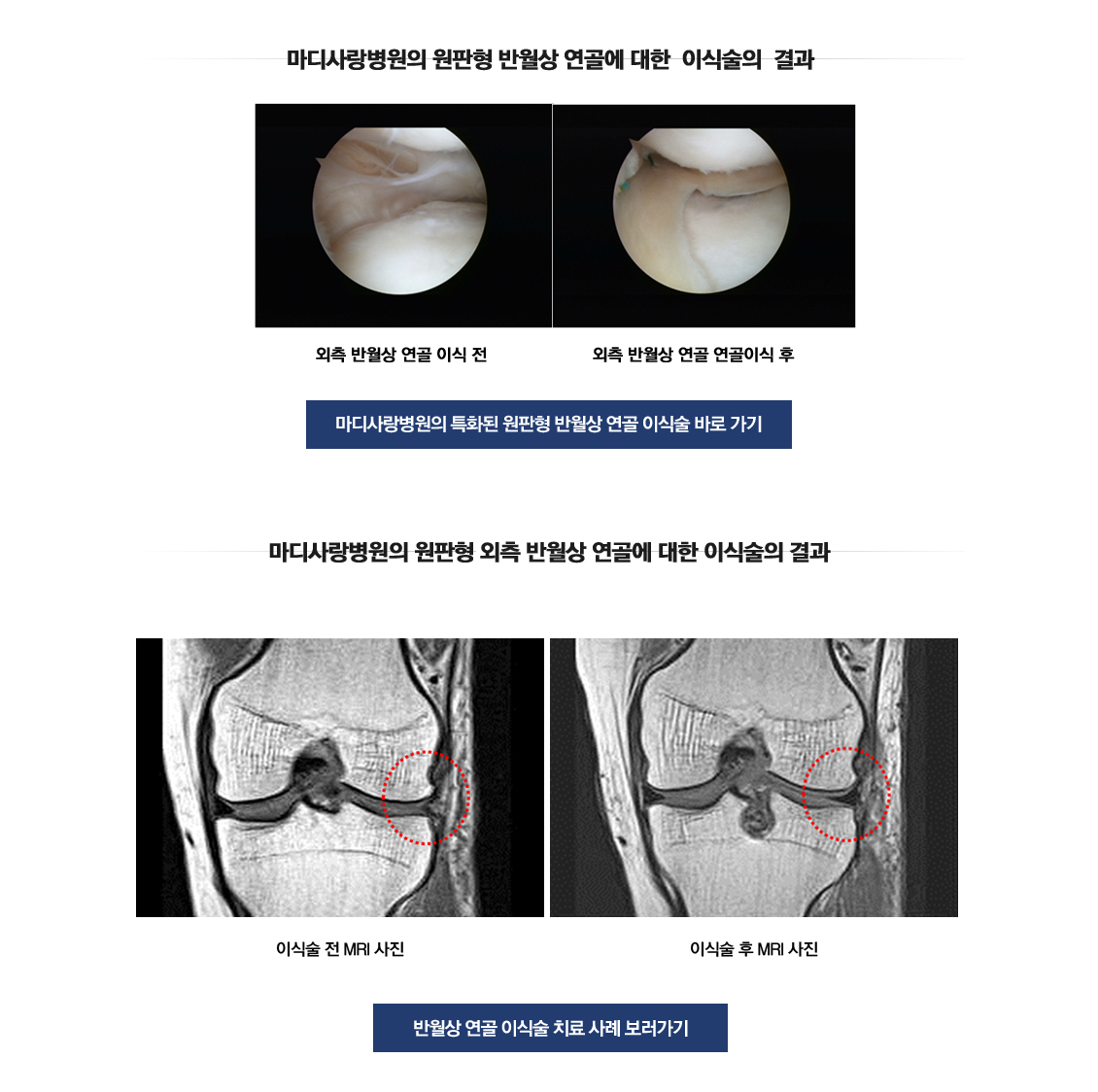 Discoid Meniscus