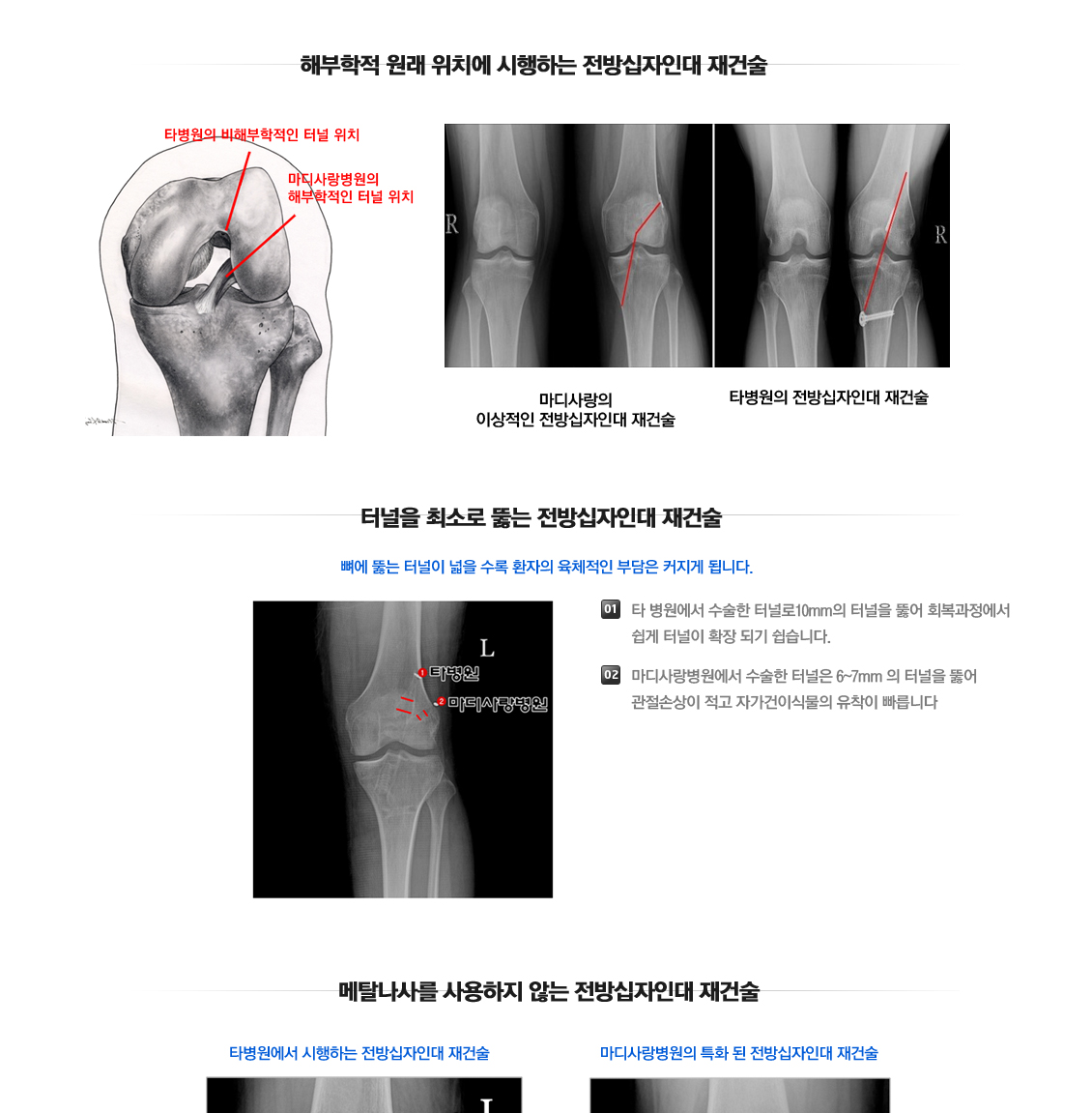 ACL Rupture