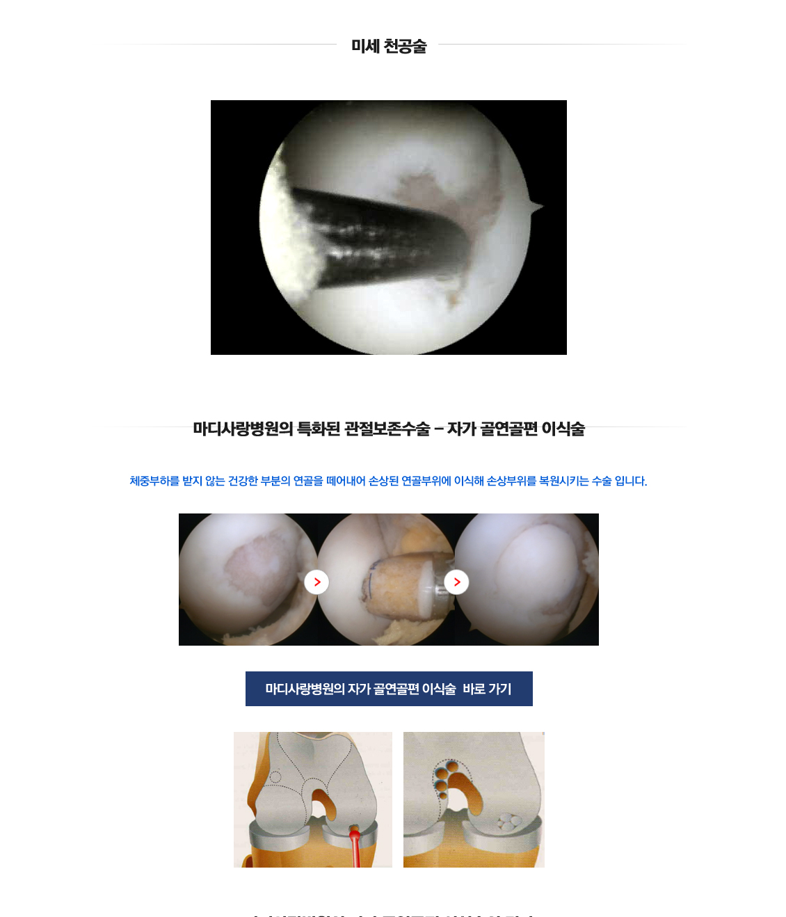 Osteoarthritis