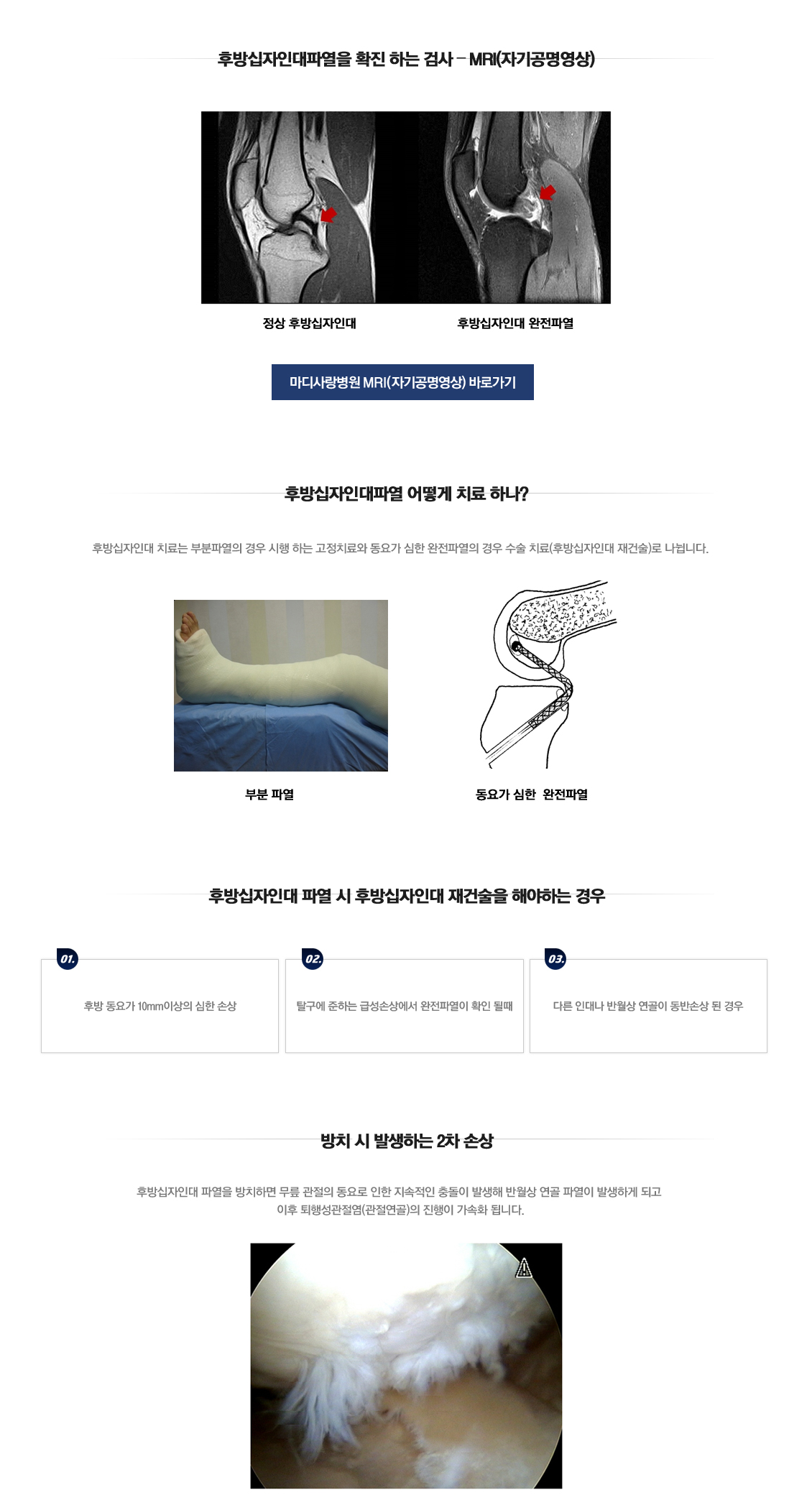 PCL Rupture