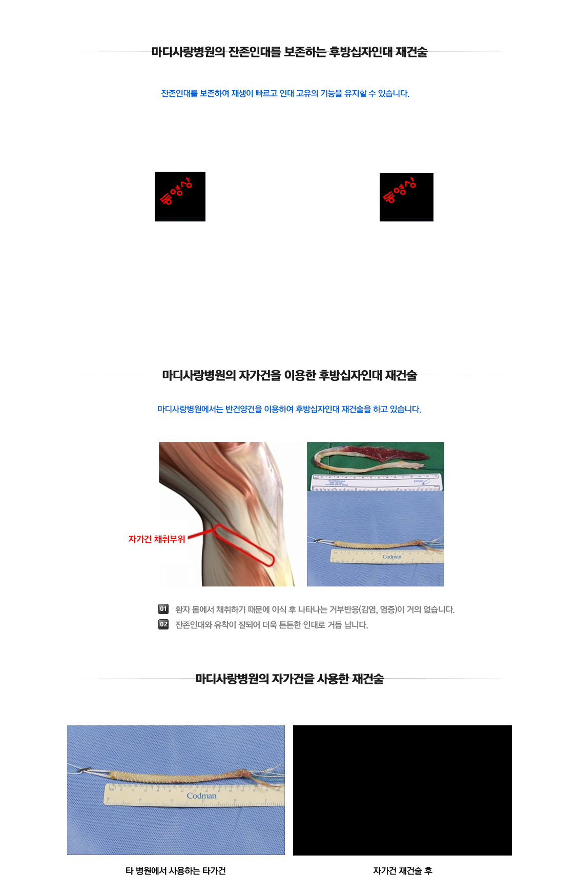 PCL Rupture