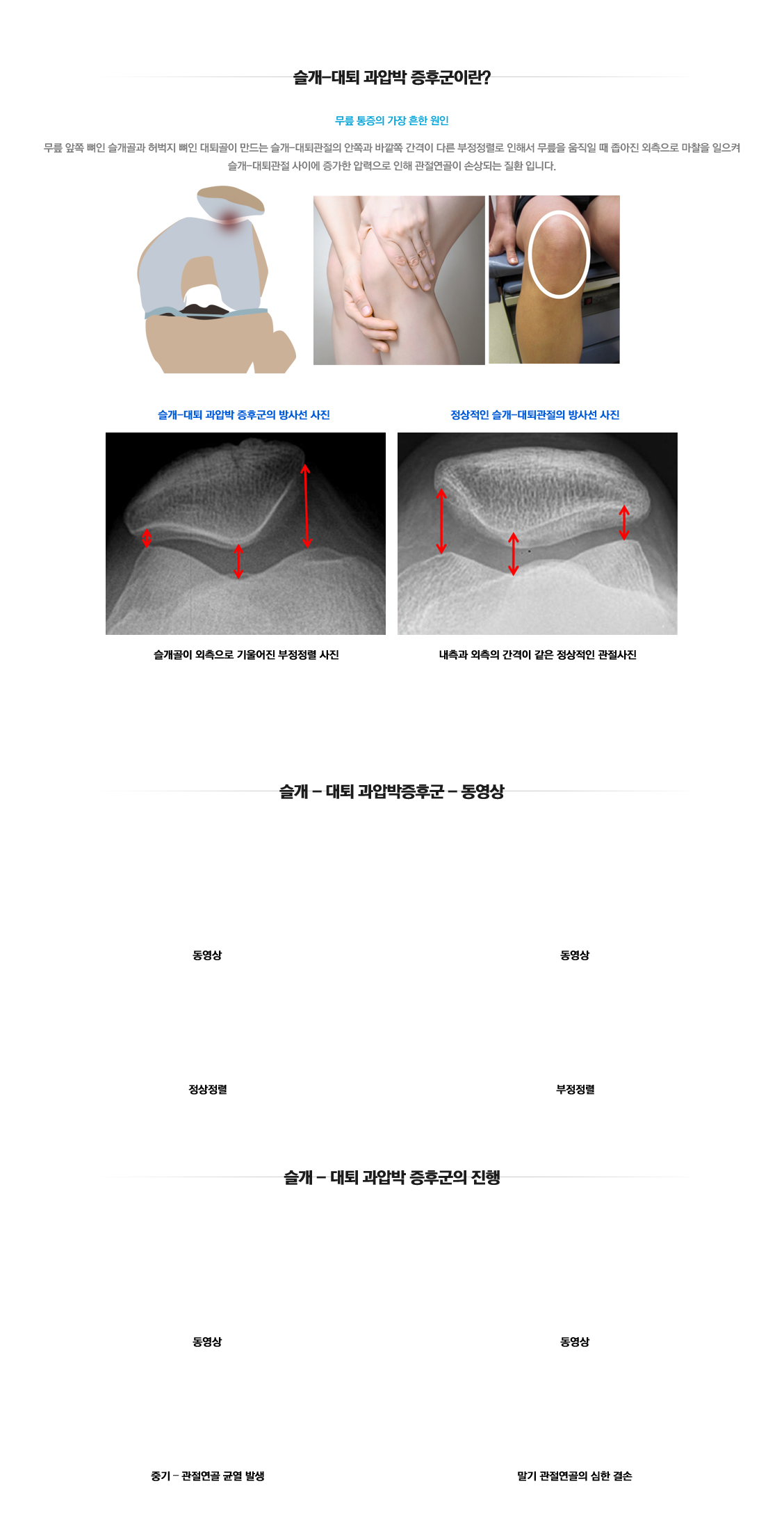 Patellofemoral hypercompression syndrome