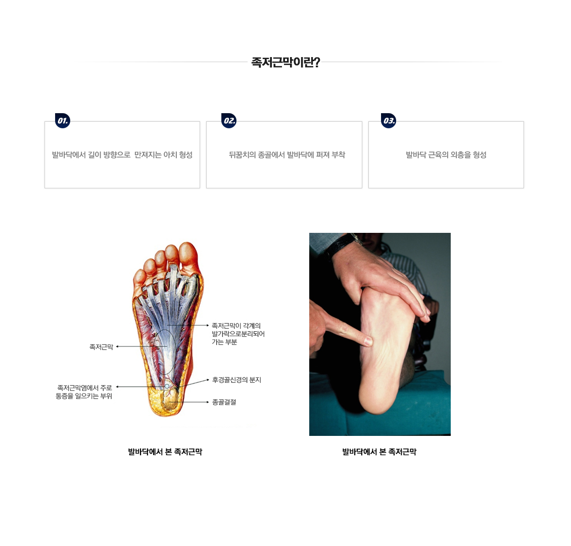 Plantar Fasciitis