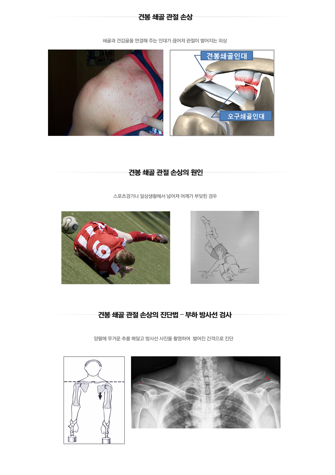 Shoulder Fracture
