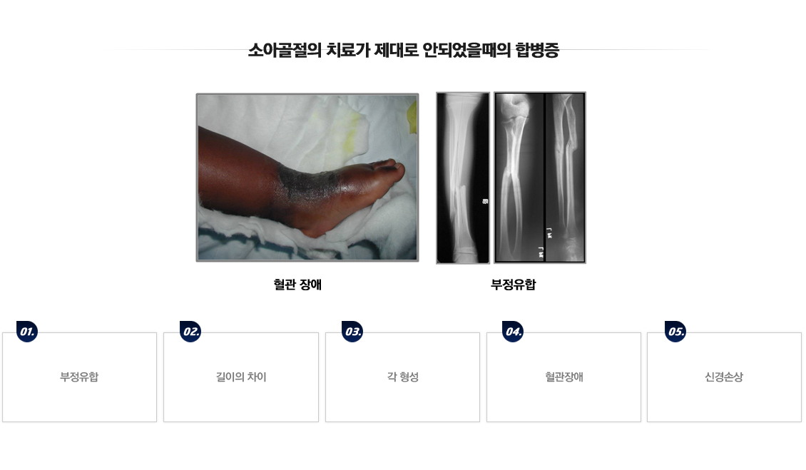 손목 관절 골절