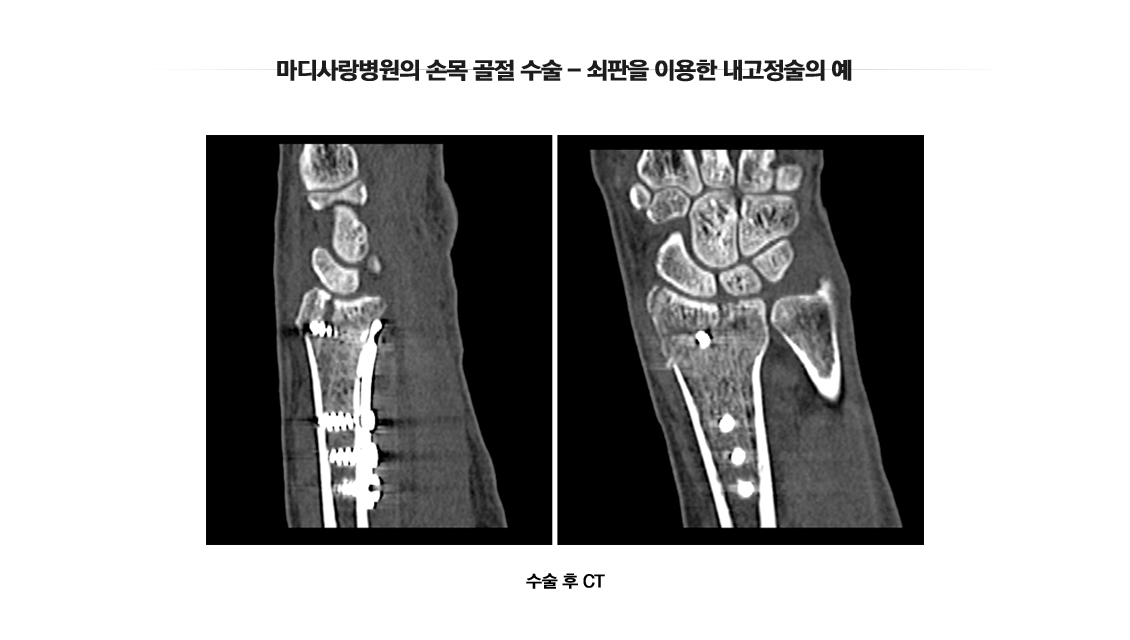 Fracture in Children