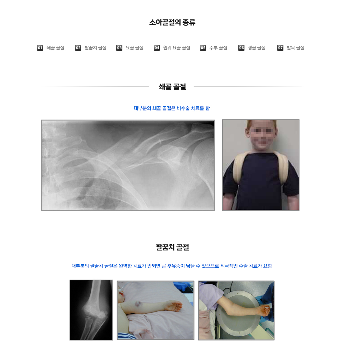 Fracture in Children