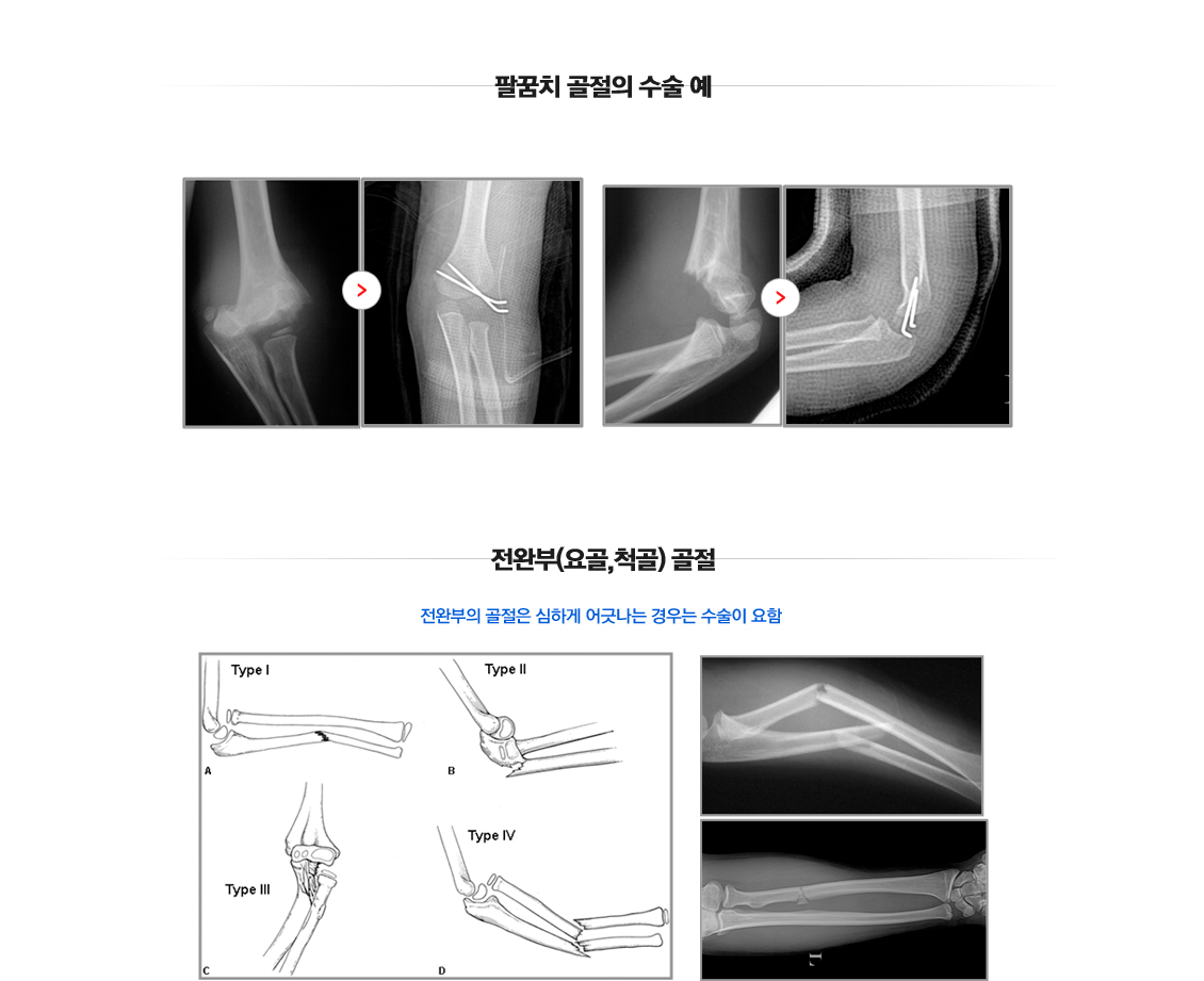 Fracture in Children