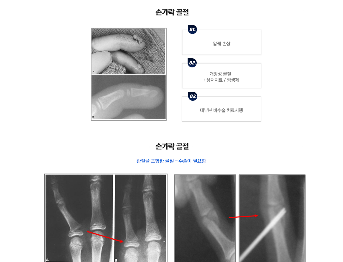 Fracture in Children