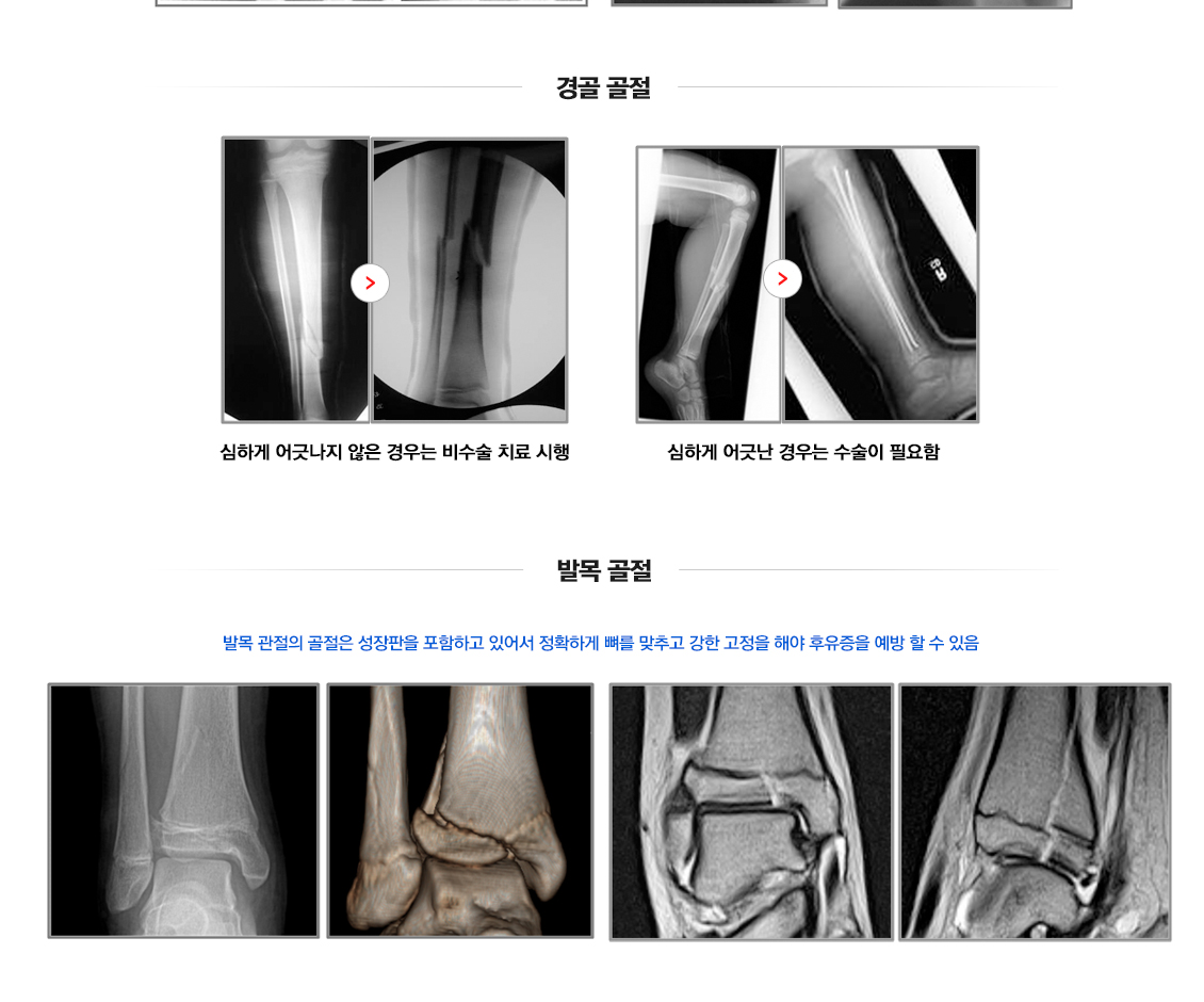 Fracture in Children