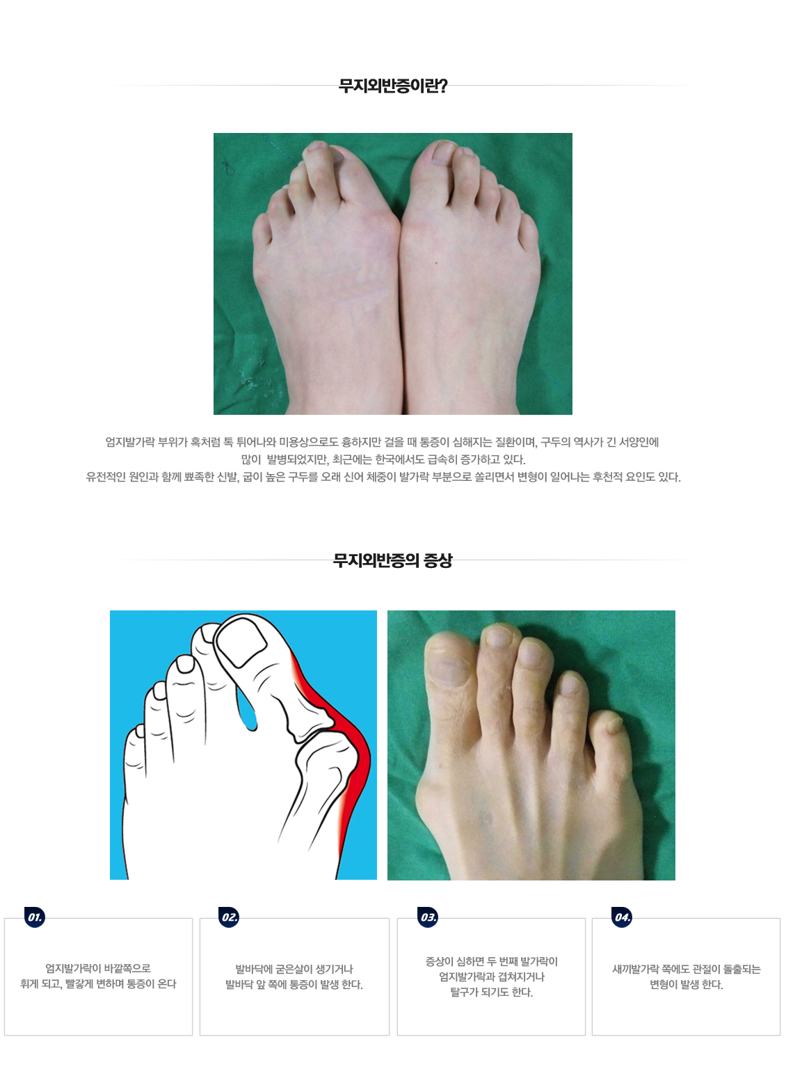 마디사랑병원 Diseases and Conditions &gt; Foot &gt; 무지외반증