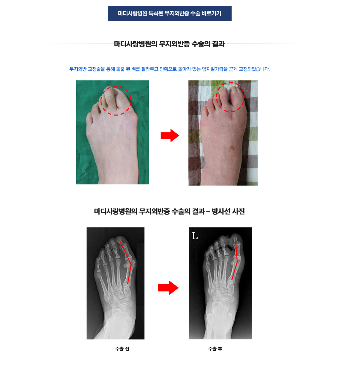 Hallux Valgus