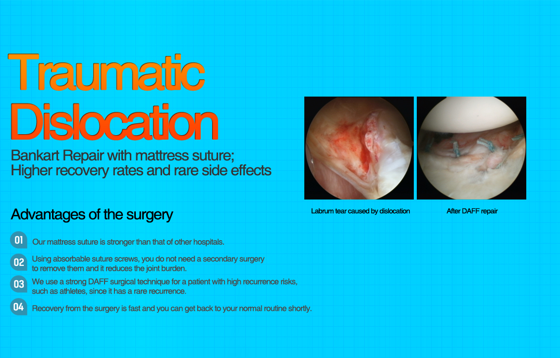 Traumatic Dislocation