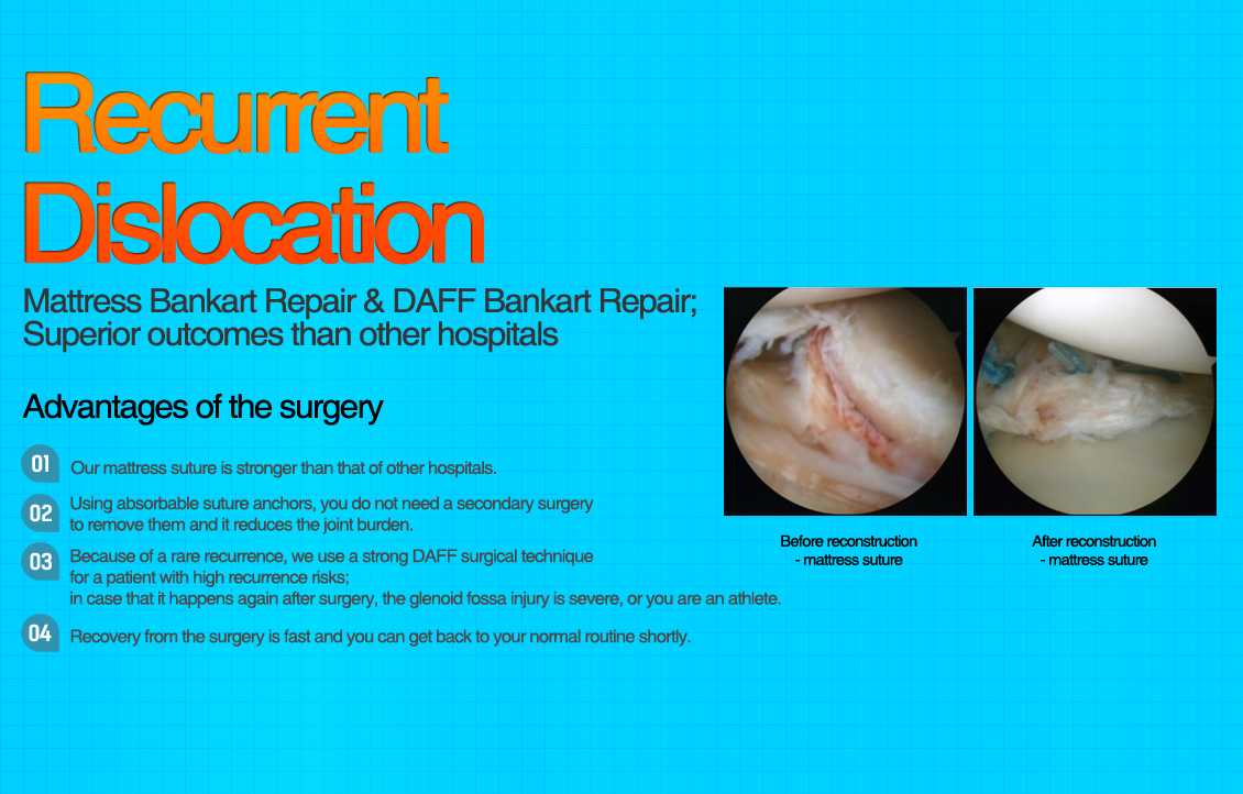 Recurrent Dislocation