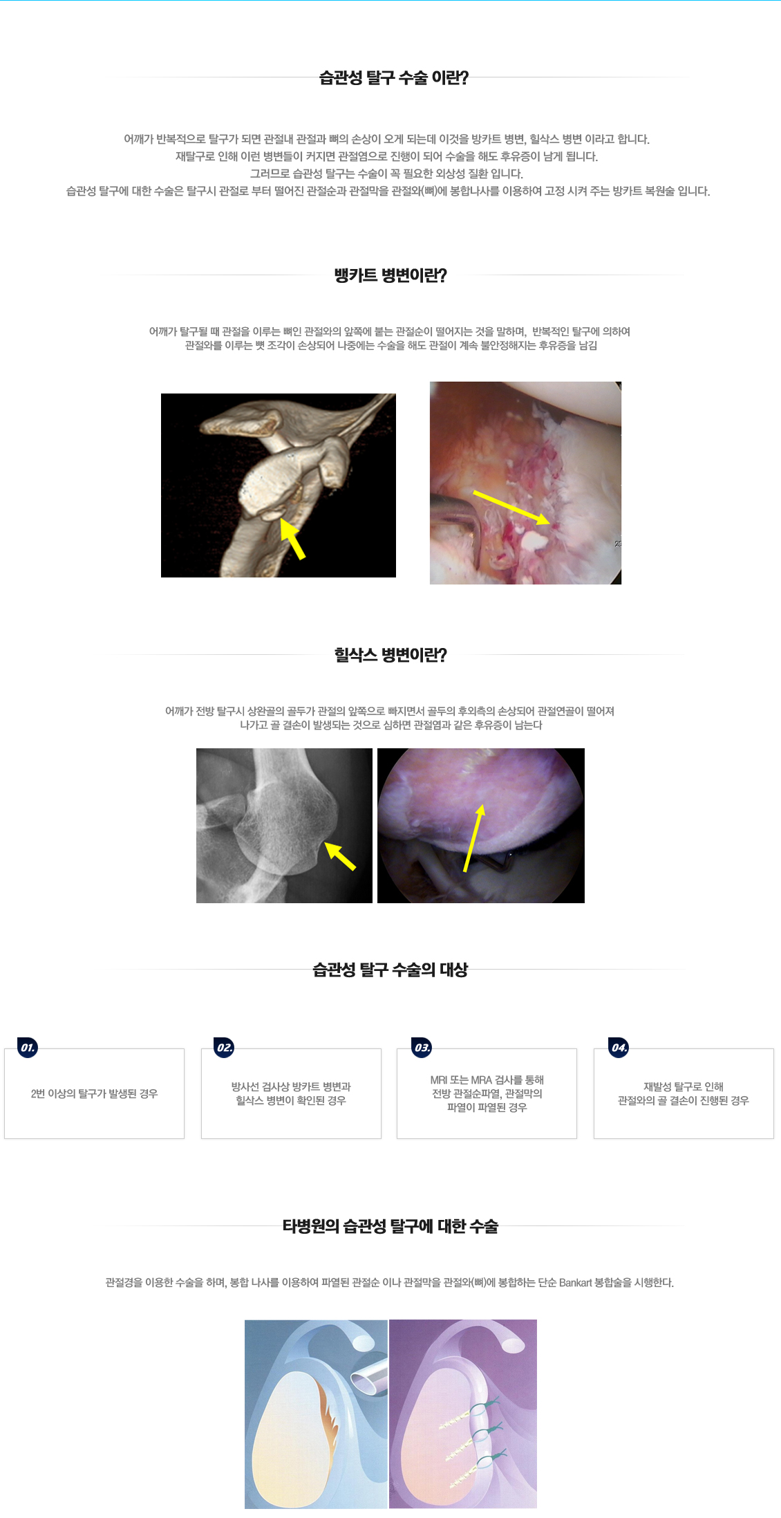 Recurrent Dislocation