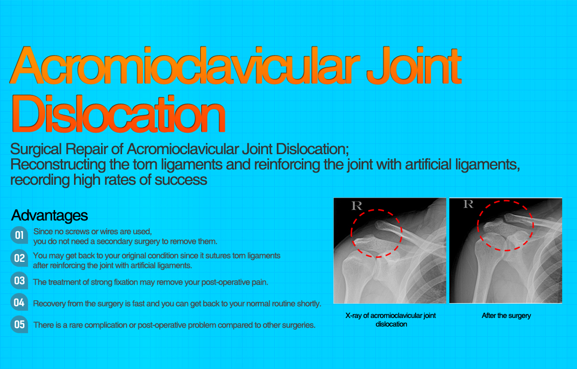 Recurrent Dislocation