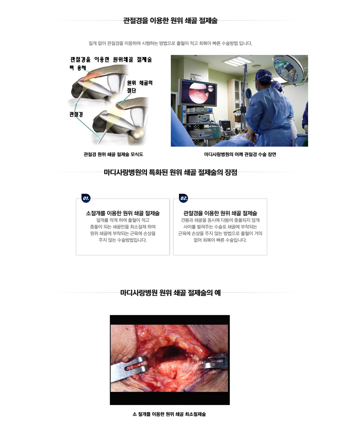 Distal Clavicle Excision