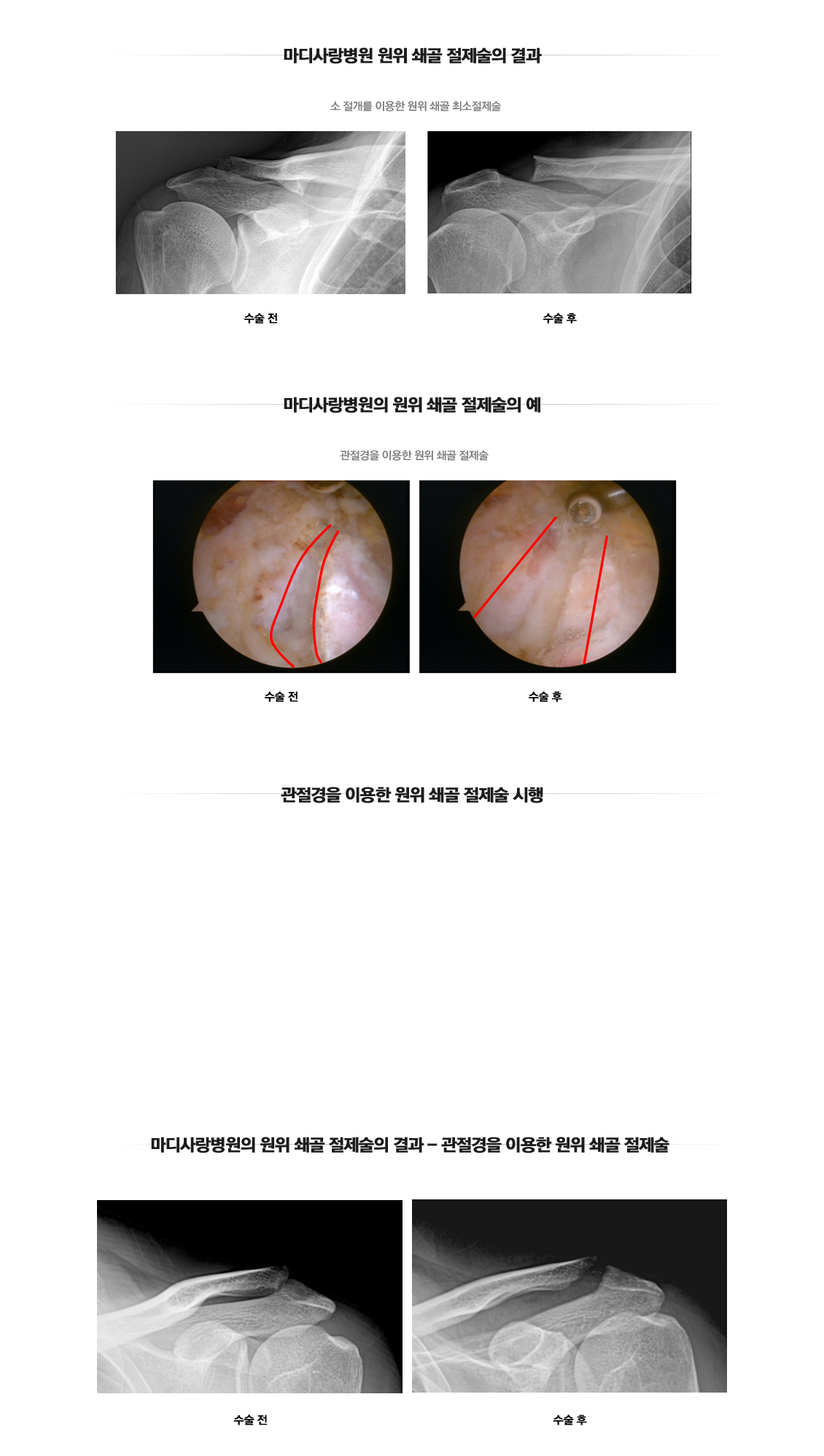 Distal Clavicle Excision