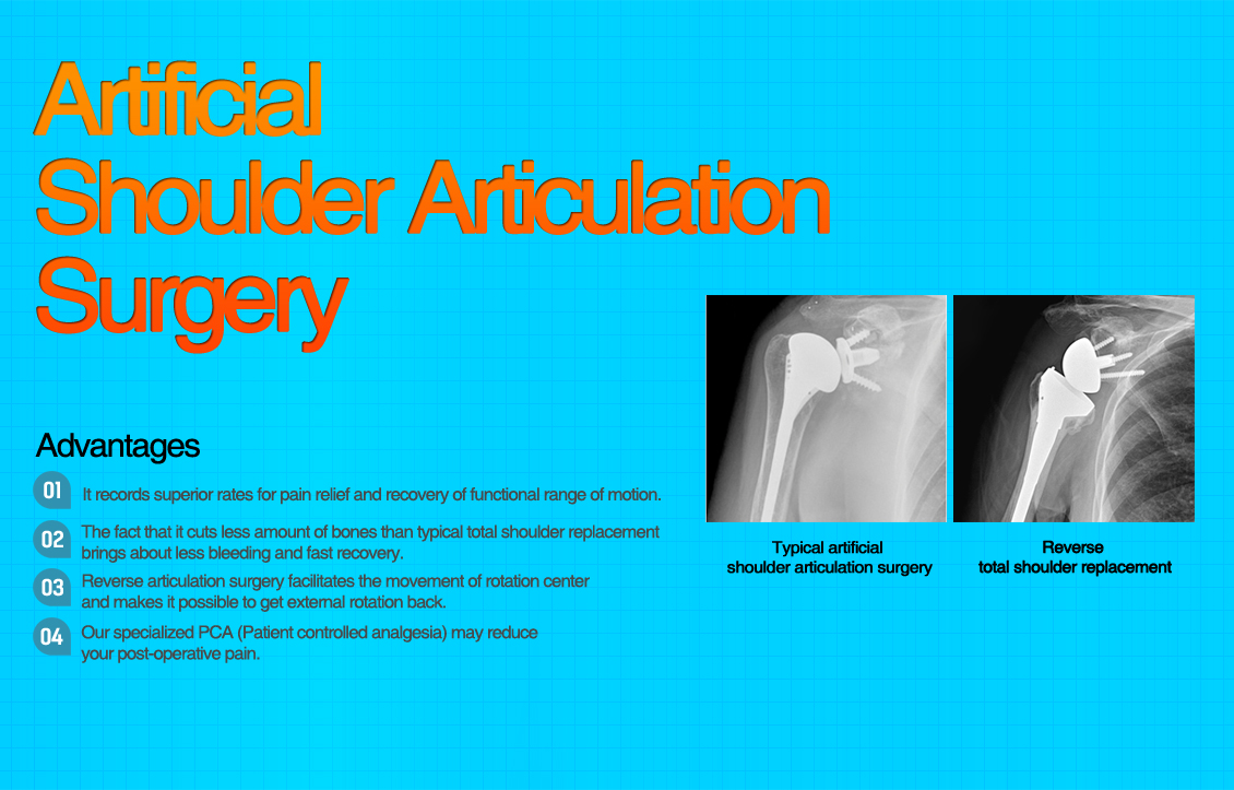 Partial Shoulder Replacement