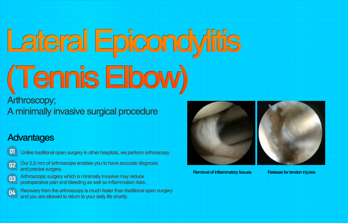 Lateral Epicondylitis