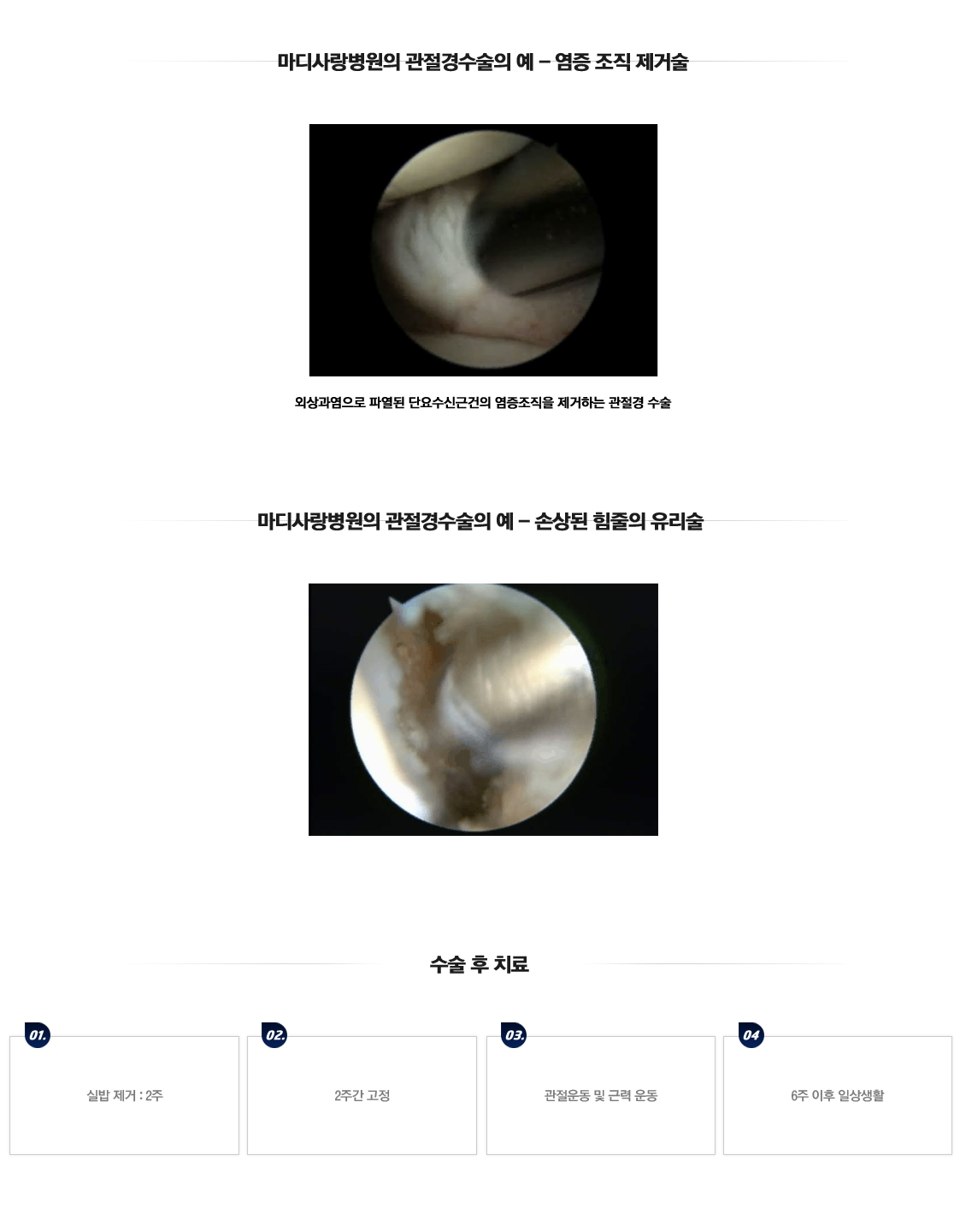 Lateral Epicondylitis