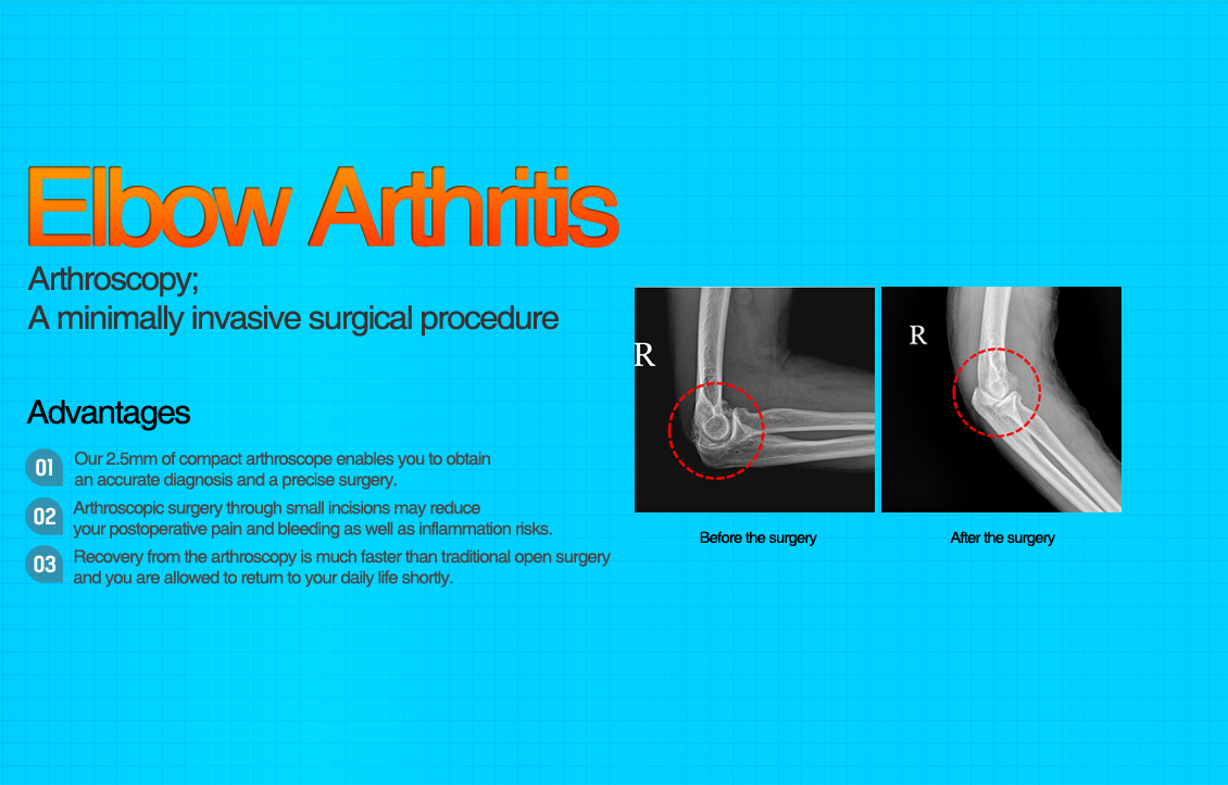 Elbow Arthritis