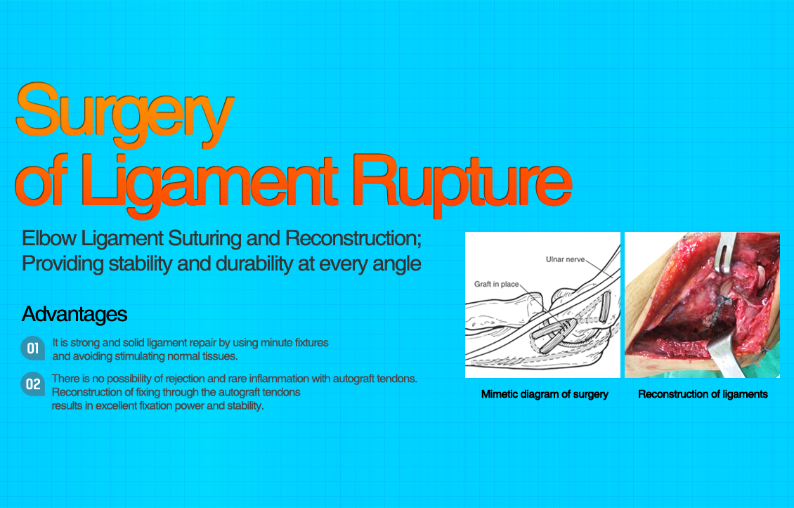 Lateral Epicondylitis