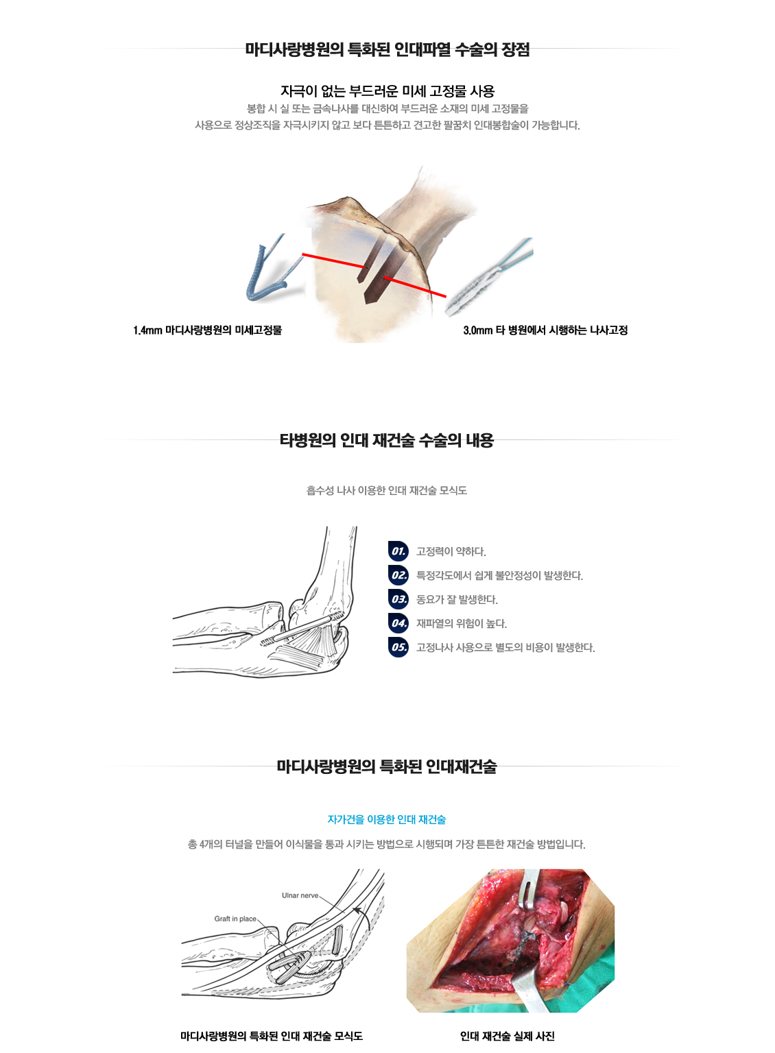 Lateral Epicondylitis