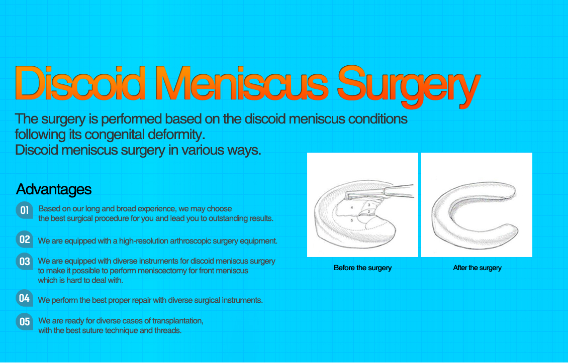 Discoid Meniscus Surgery