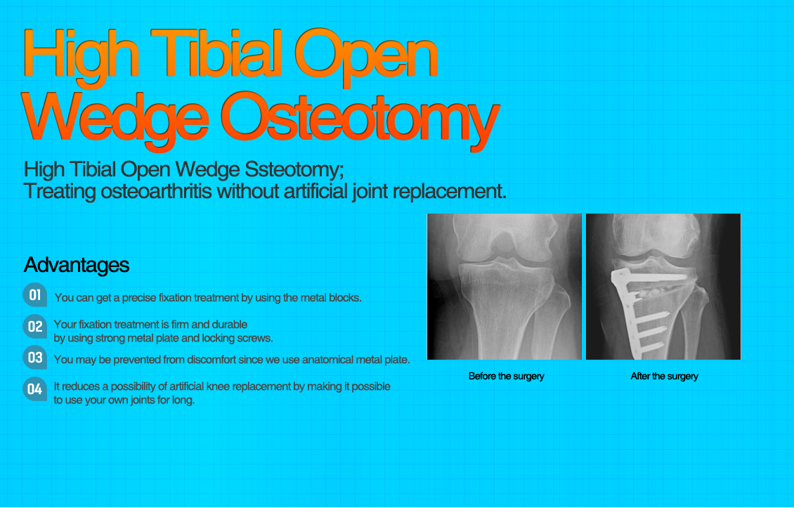 High Tibial Open Wedge Osteotomy