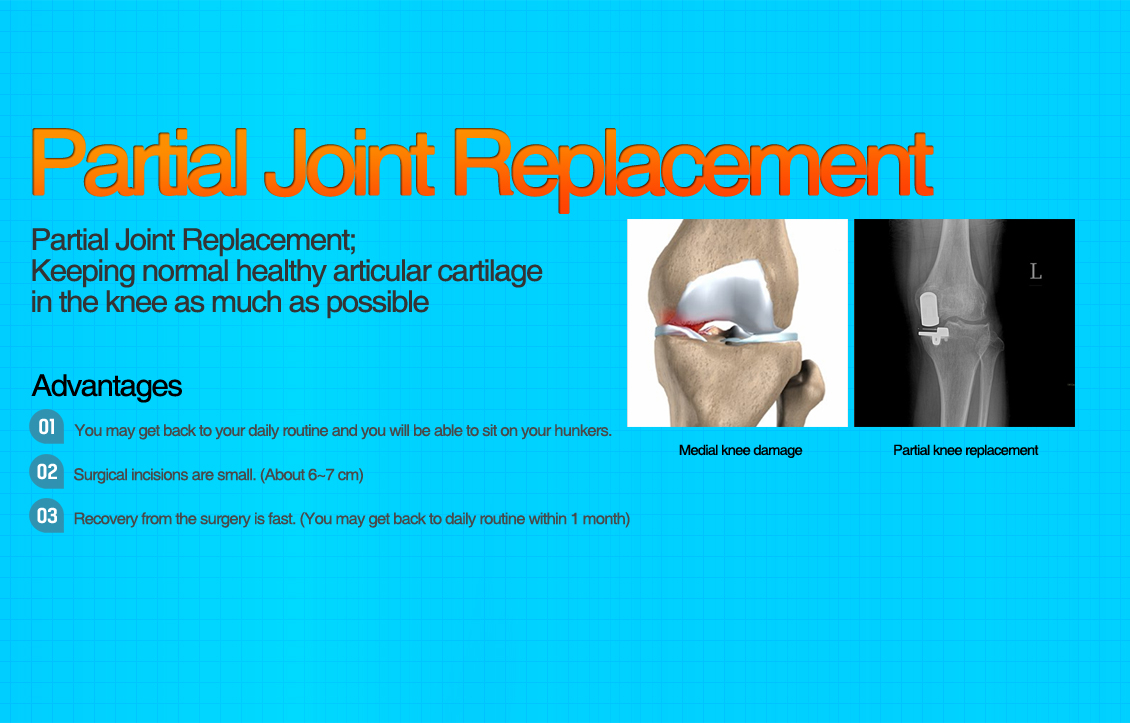 Partial Joint Arthroplasty