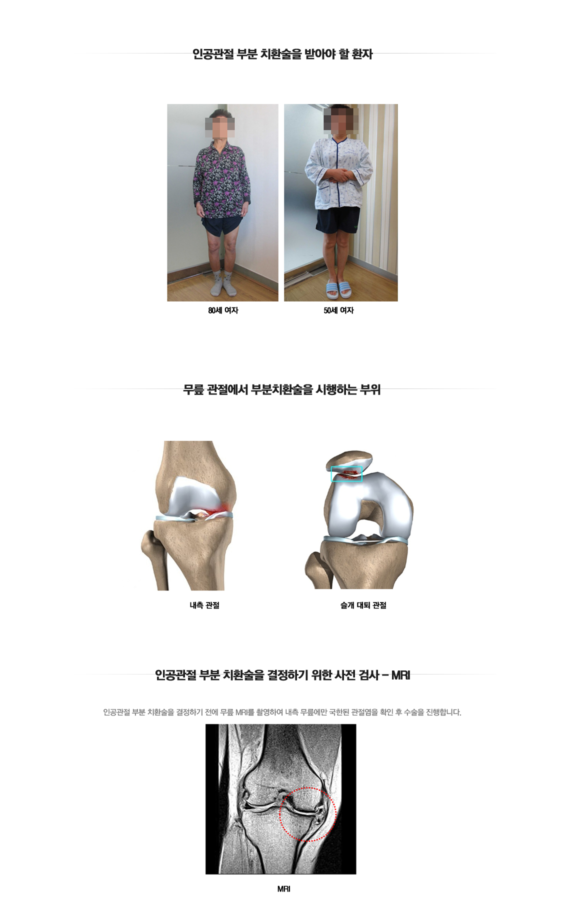 Partial Joint Arthroplasty