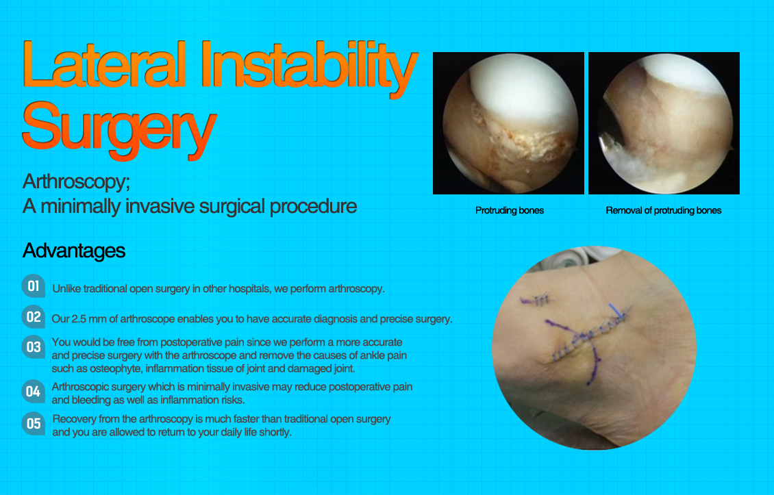 Lateral Ankle Instability Surgery