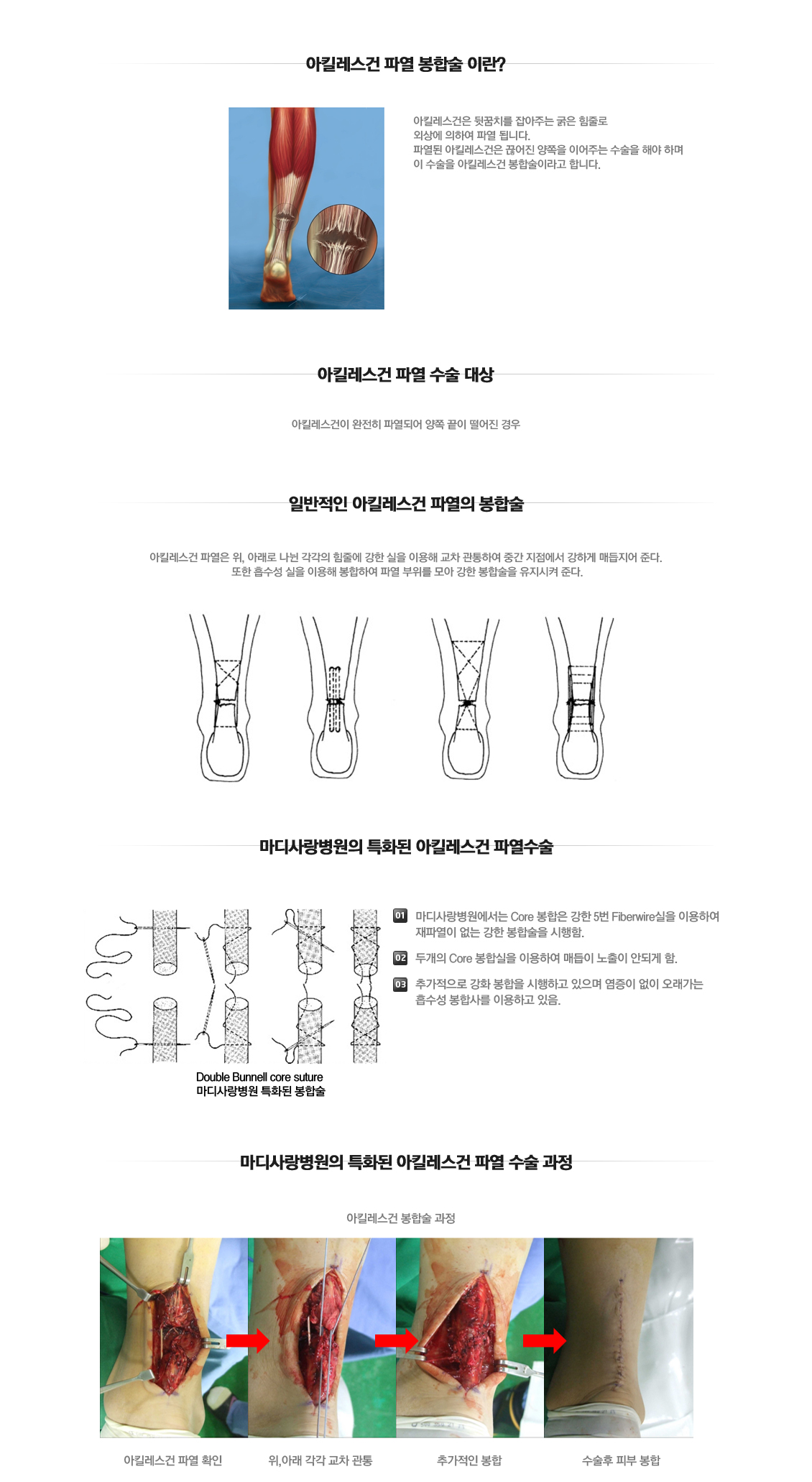 Lateral Ankle Instability Surgery 