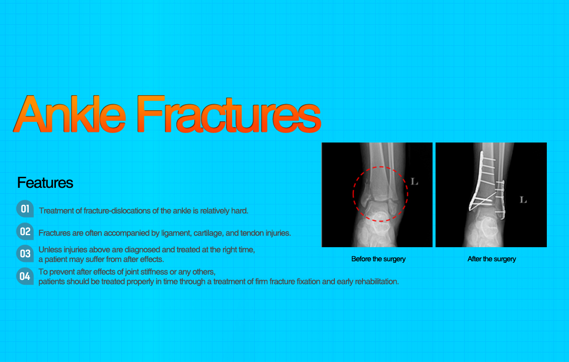 Lateral Ankle Instability Surgery