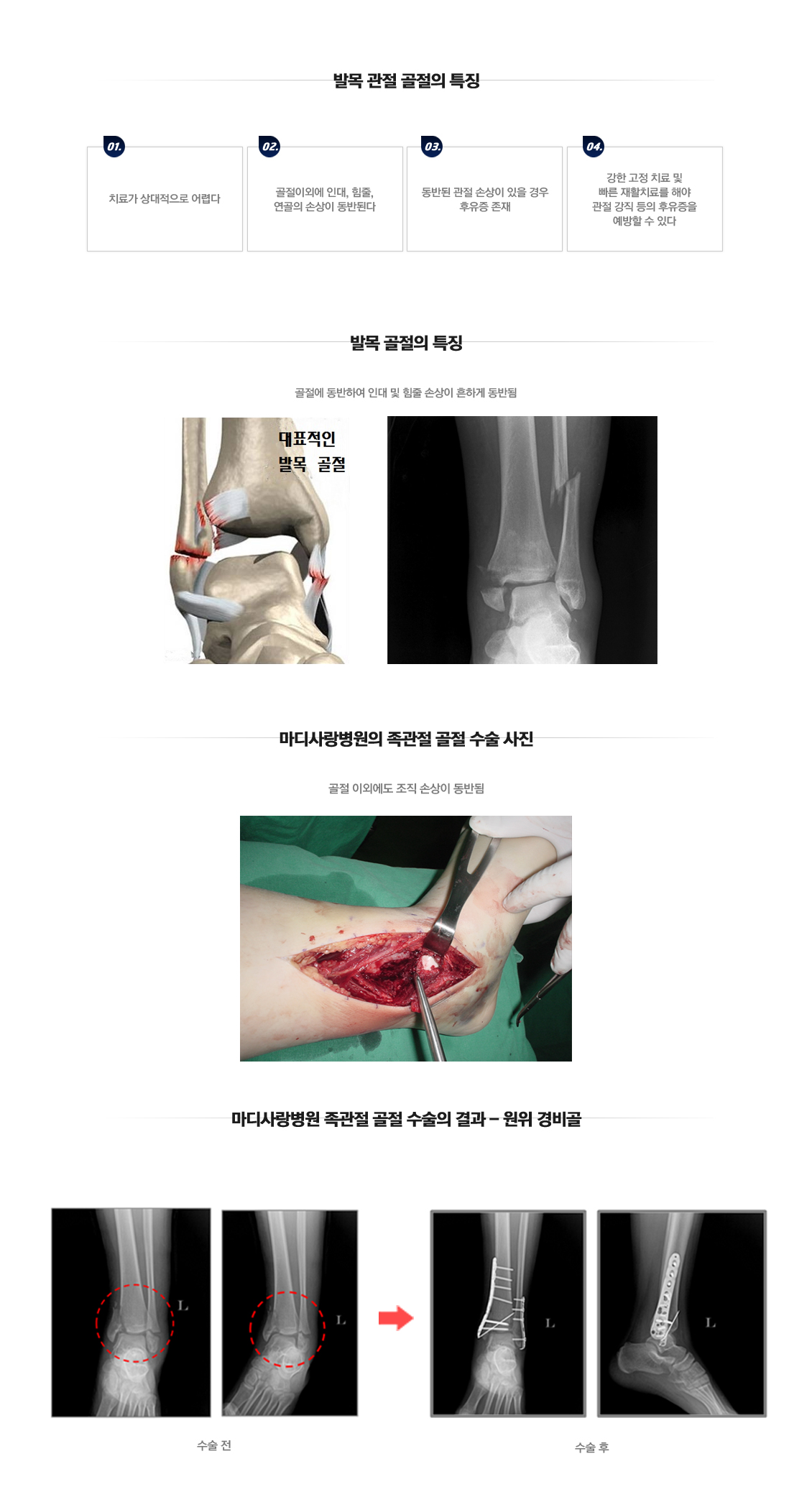 외측불안정성 수술 