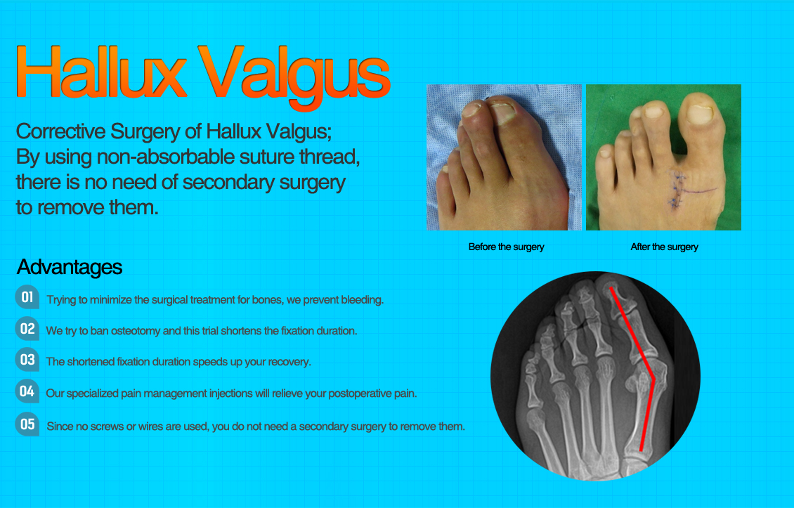 Hallux Valgus