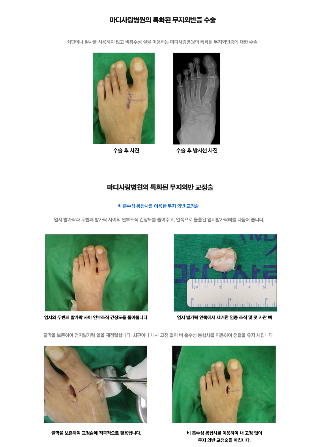 Hallux Valgus