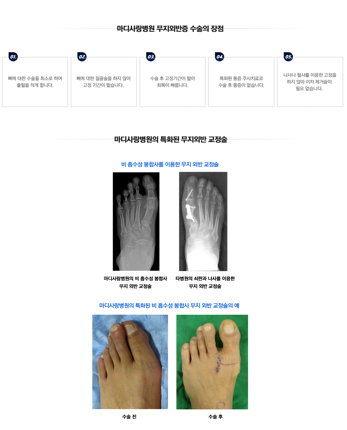 Hallux Valgus