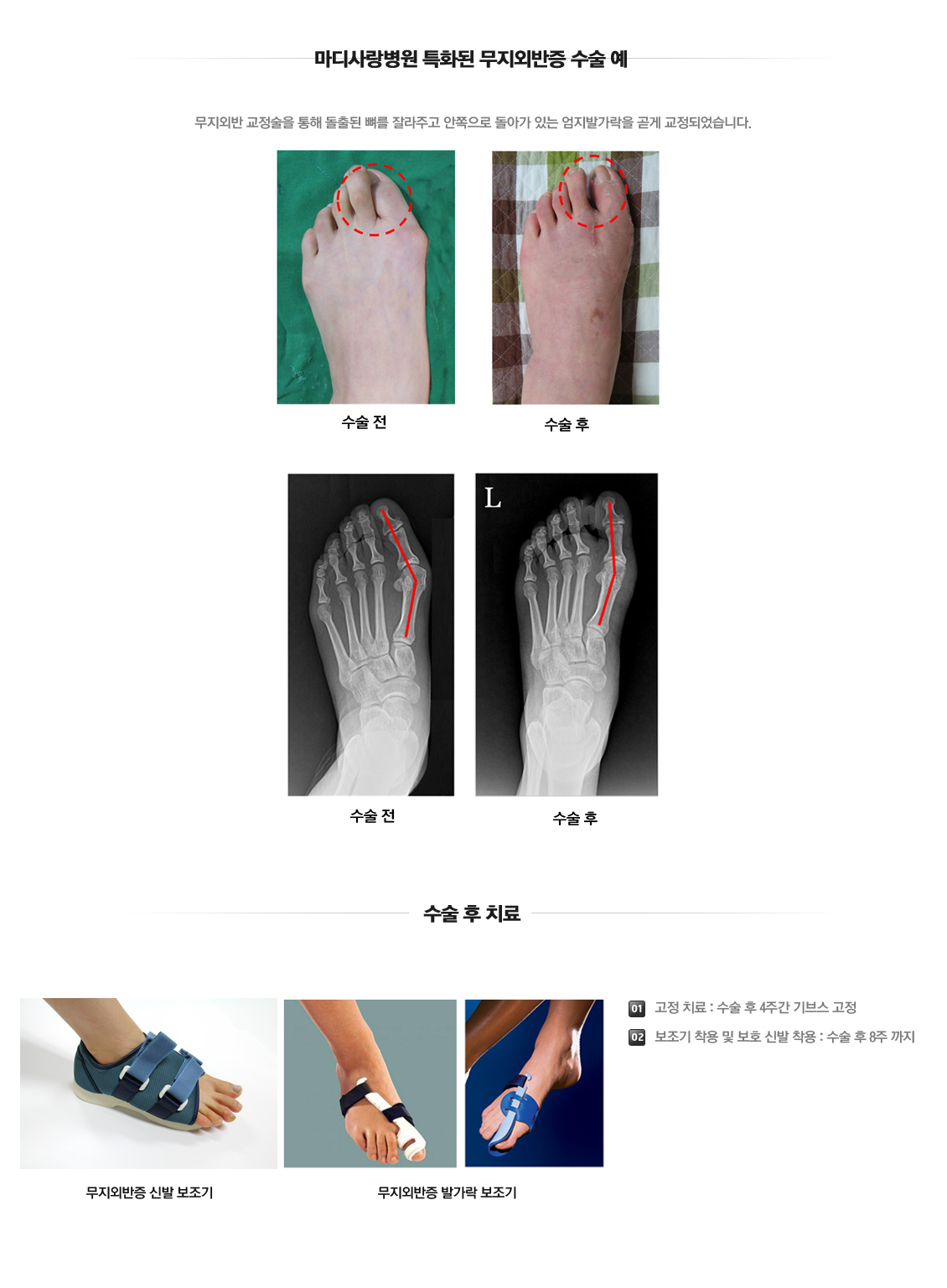 Hallux Valgus