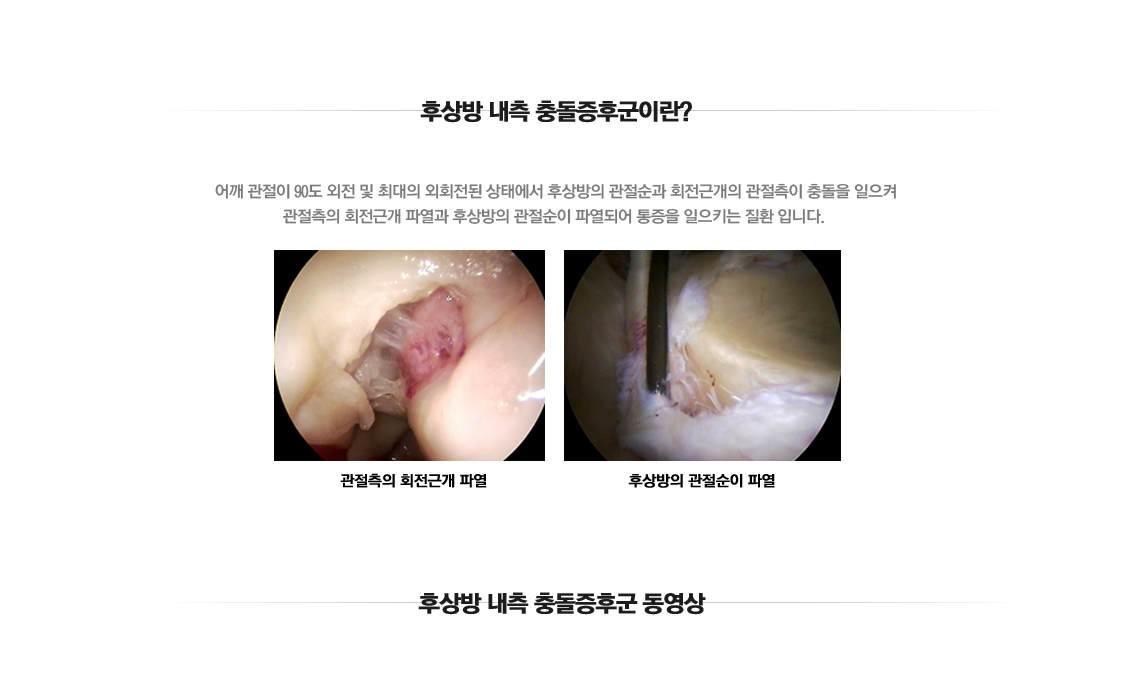 후상방내측충돌증후군