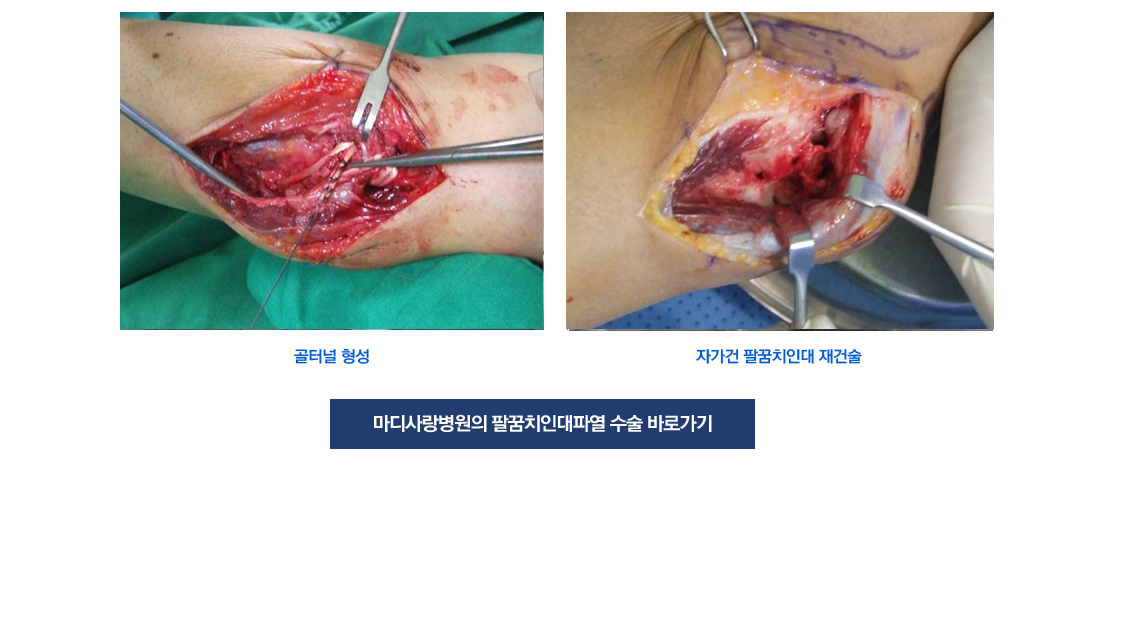 팔꿈치 증상별 진단 